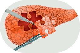 Transplante do Fígado